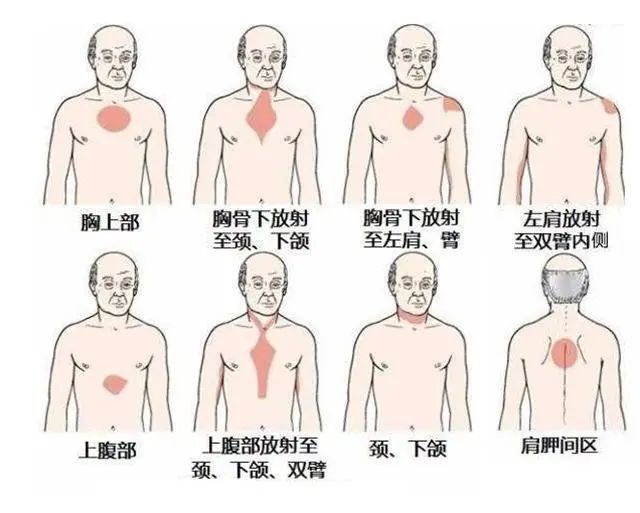 心绞痛